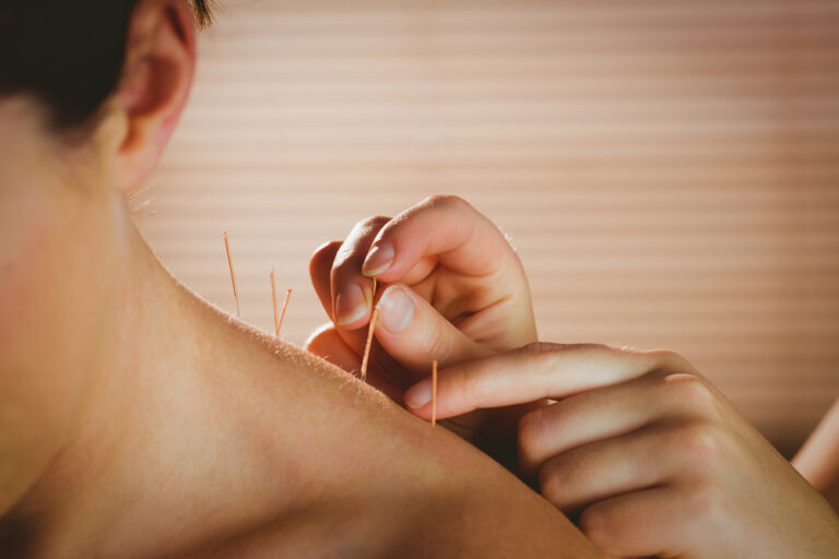 A Complete Guide To Acupuncture For Sports Injuries